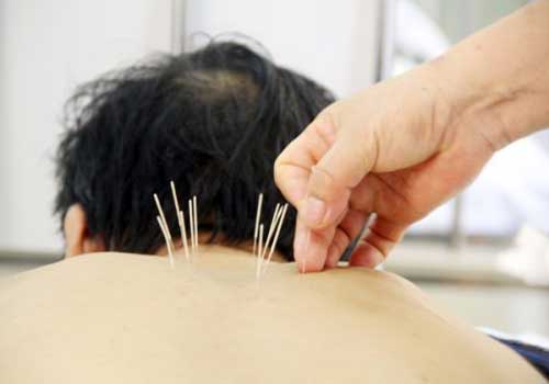 Phương pháp châm cứu bấm huyệt đơn giản tại nhà